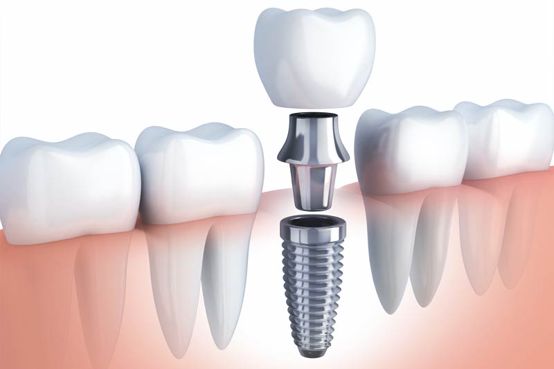 Implants Dentist in East Hampton